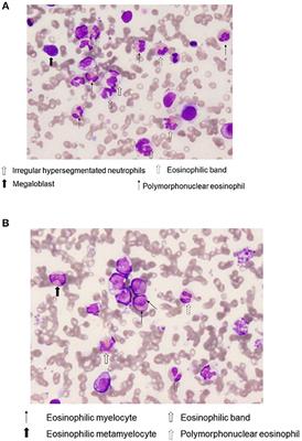 Severe Eosinophilia in Myelodysplastic Syndrome With a Defined and Rare Cytogenetic Abnormality